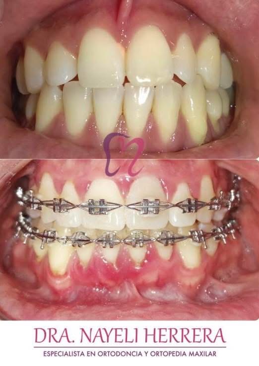 Dra. Nayeli Herrera. Dentista en Morelia, Otras zonas