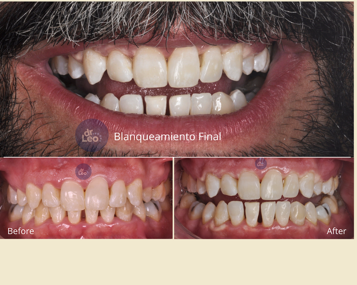 Dr. Leo I Carillas, Diseño de Sonrisa y Rehabilitacion Oral, Otras zonas