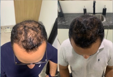 Tricologo Dr. Jorge Cambron - Injerto de Cabello, barba y ceja, Las Américas