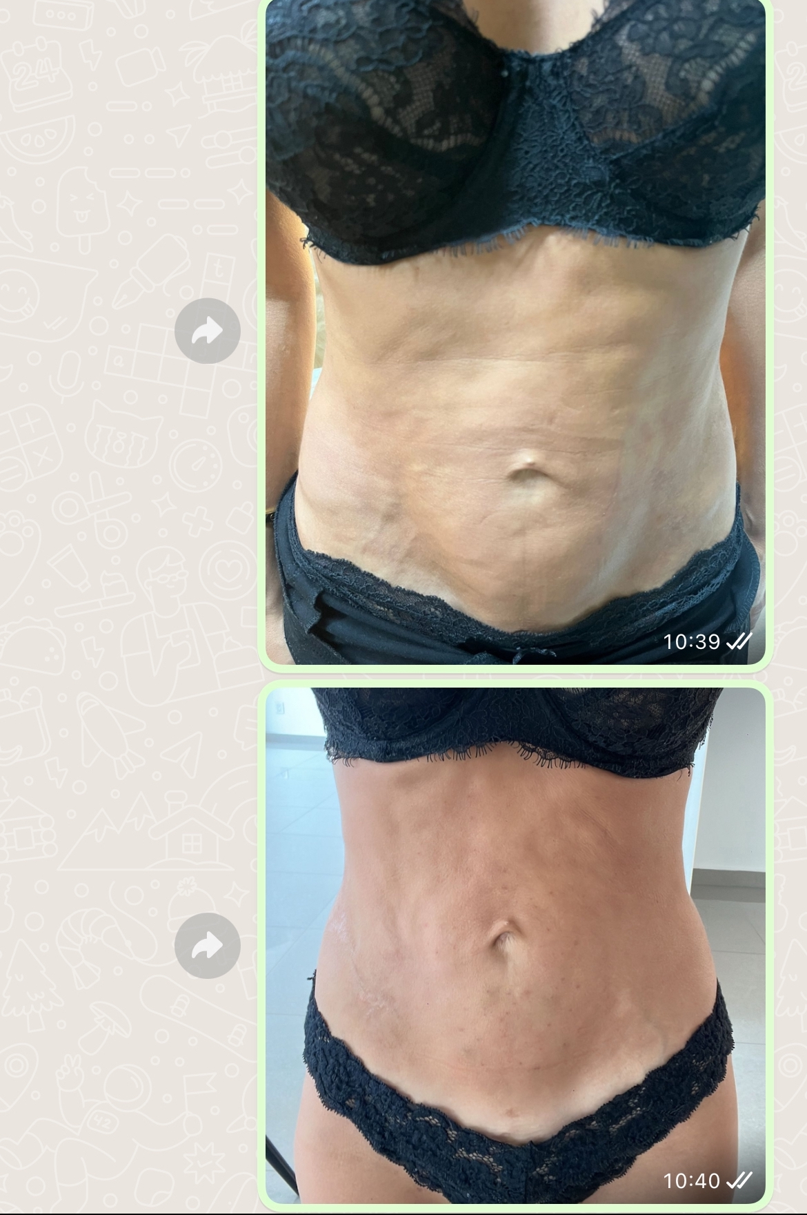 Regenerativa. Desvanecer Estrías. Fibrosis post Liposucción, Roma