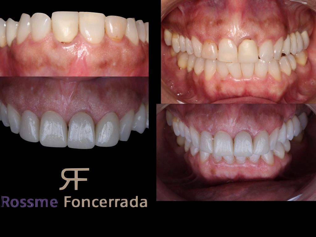 Rehabilitacion oral, PUEBLA